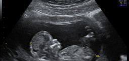Ultralydbilde av 12 uker gammelt foster.